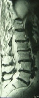 IRM rétrécissement du canal lombaire avec hernie discale L5 S1