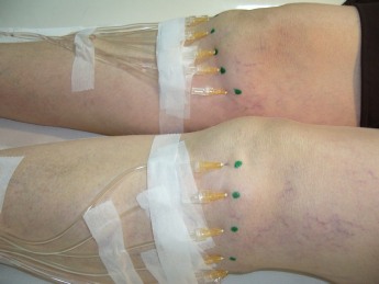 Traitement d une arthrose des deux genoux